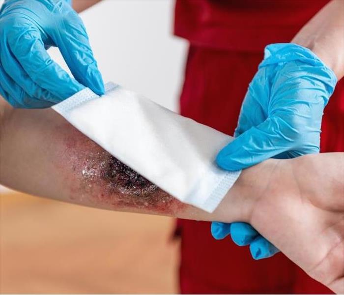 Bandaging a burned arm